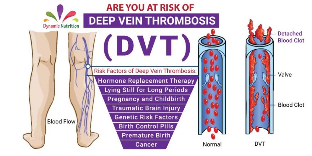 Are you at Risk of Deep Vein Thrombosis (DVT)? | Dynamic Nutrition